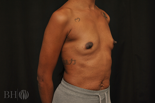 Breast Augmentation With Lift Before & After